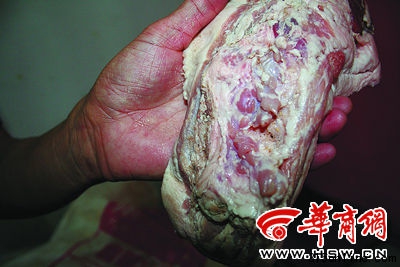 甲狀腺未摘除干凈的“雨潤(rùn)問(wèn)題肉” 甲狀腺未摘除干凈的“雨潤(rùn)問(wèn)題肉”