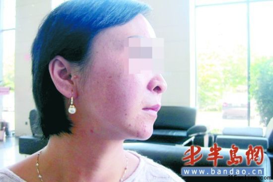 徐女士的臉上經(jīng)過祛斑美容后,反倒長了不少小痘痘。 徐女士的臉上經(jīng)過祛斑美容后,反倒長了不少小痘痘。